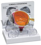 Cornea Eye Model Cross-Section w/ Patient Education Card